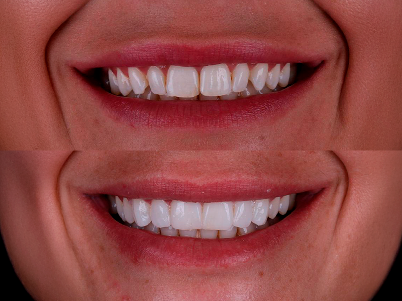 Caso 01 — Antes e Depois