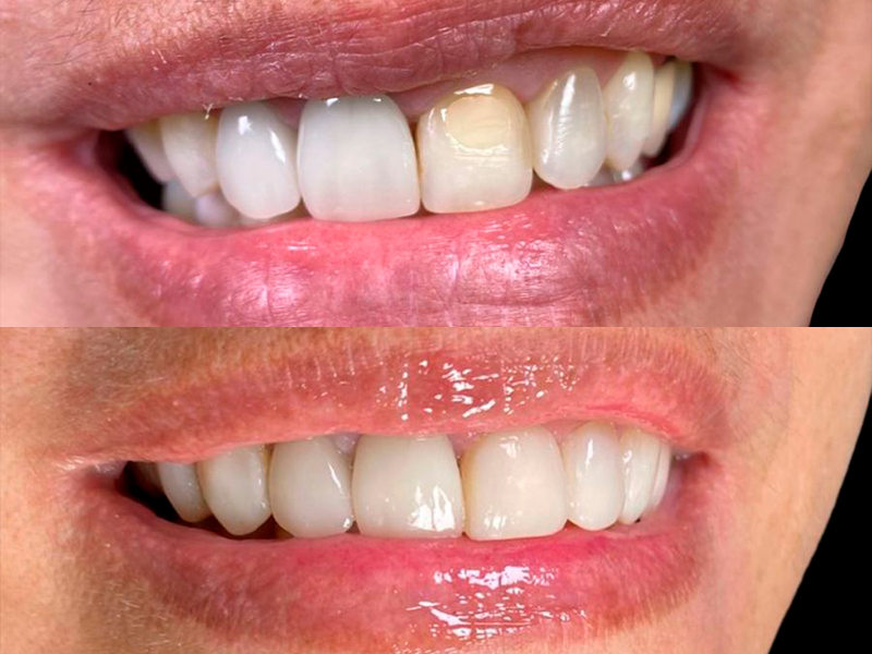 Caso 02 — Antes e Depois